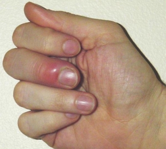 Что делать, если нарывает палец на руке возле ногтя