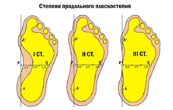 Степени плоскостопия