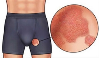 Как лечить паховую эпидермофитию