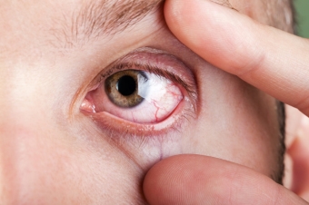 Что такое глазной клещ и как его лечить