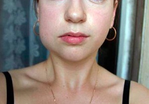 Отек после вмешательства