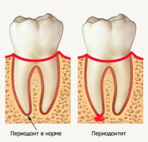 Особенности форм периодонтита