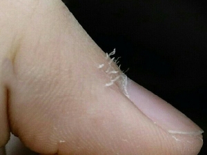 Причины возникновения проблем с кожей вокруг ногтей