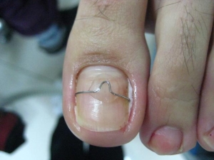 Скоба Фрейзера