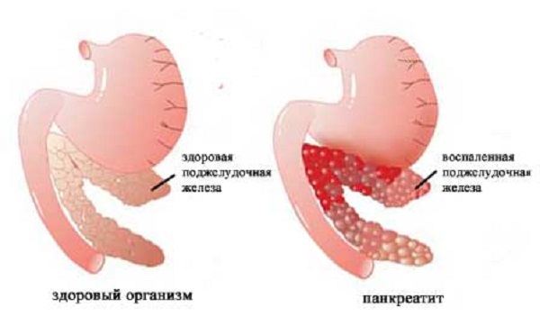 Острый панкреатит 