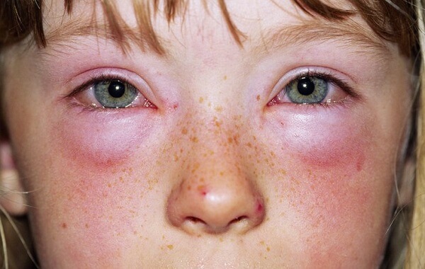 Аллергический дерматит глаз