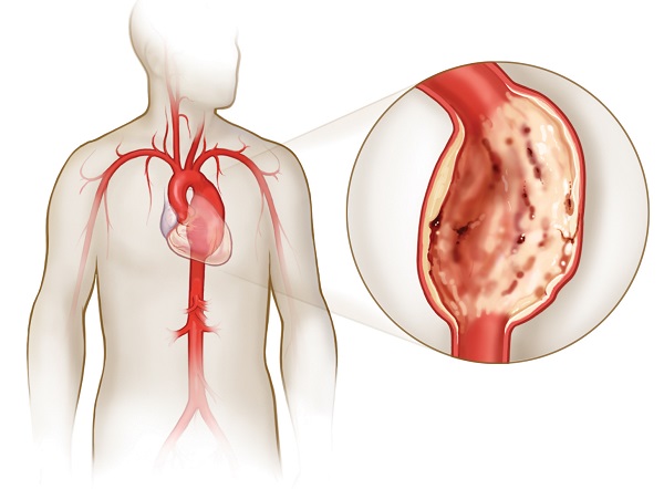 Аневризм аорты