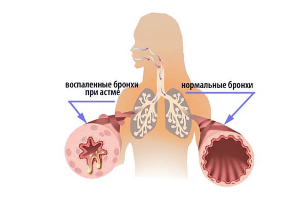 Атопическая бронхиальная астма что это
