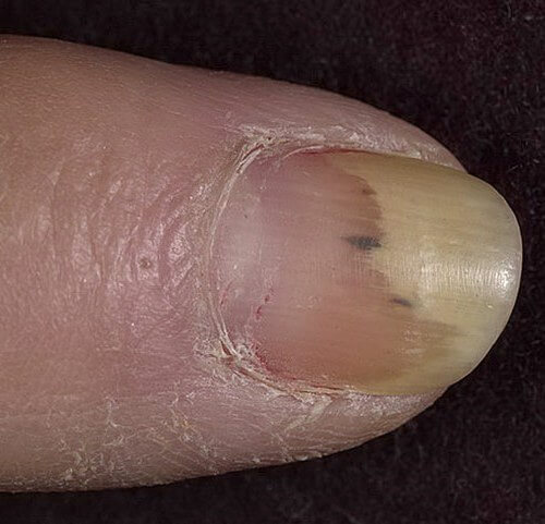 Быстро избавляемся от онихолизиса 