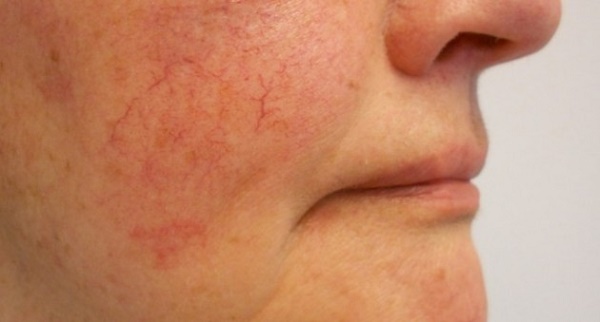 Что такое купероз кожи лица