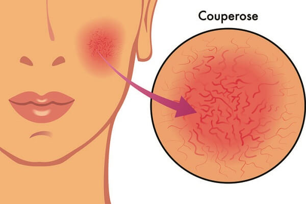 Что такое купероз