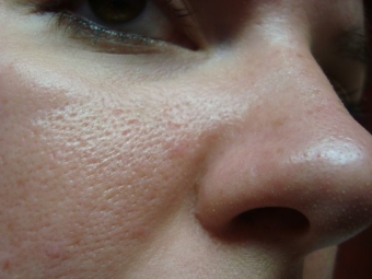 Как избавиться от пористой кожи на лице