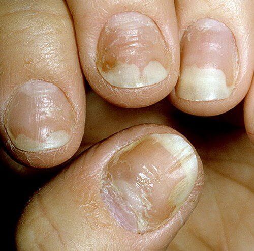 Эффективно лечим онихолизис 