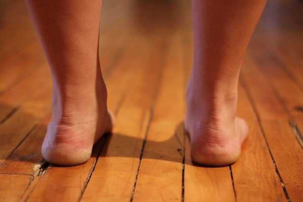 Причины возникновения плоскостопия