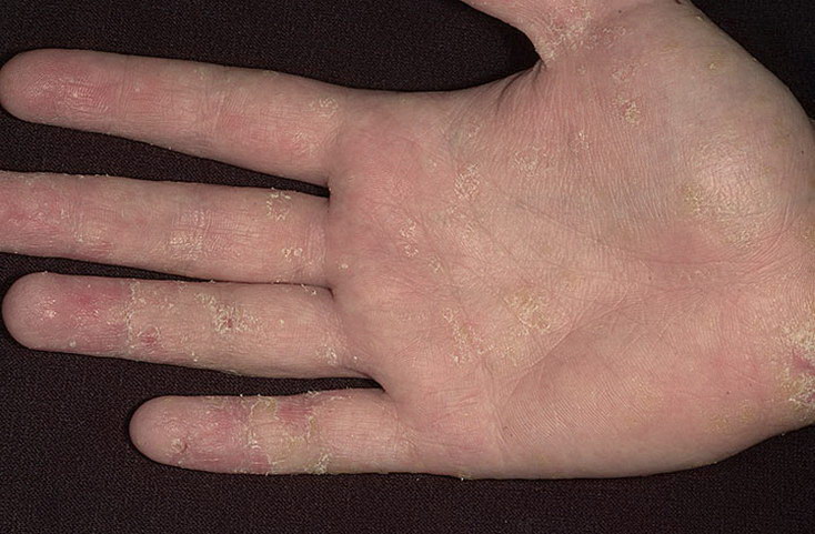 Эксфолиативный дерматит