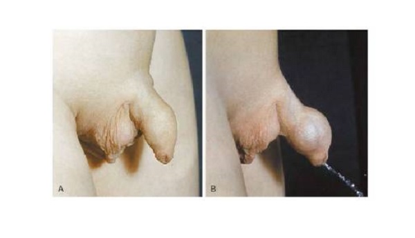 Фимоз что это