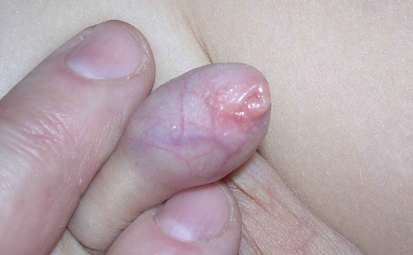 Фимоз врожденный