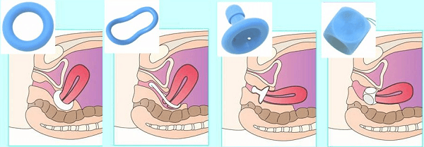 Гинекологический пессарий