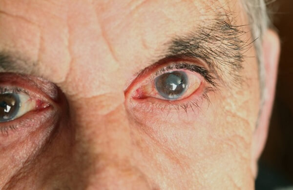 Глаукома у пожилых людей
