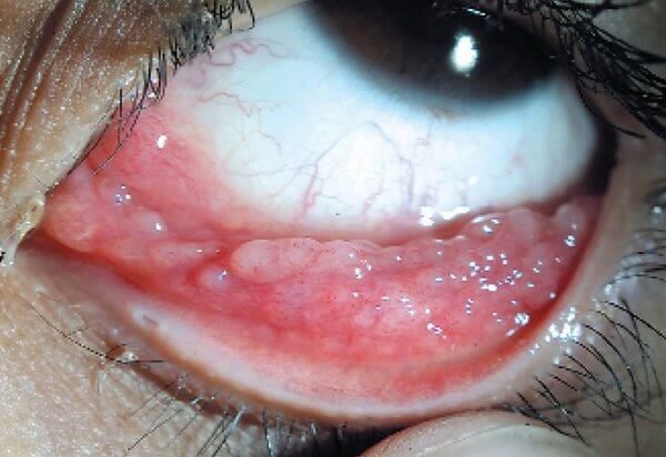 Хламидийный конъюнктивит как выглядит