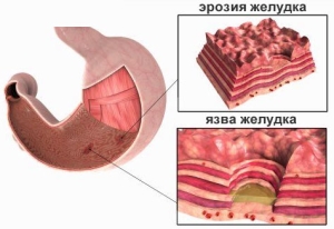 Последствия и осложнения