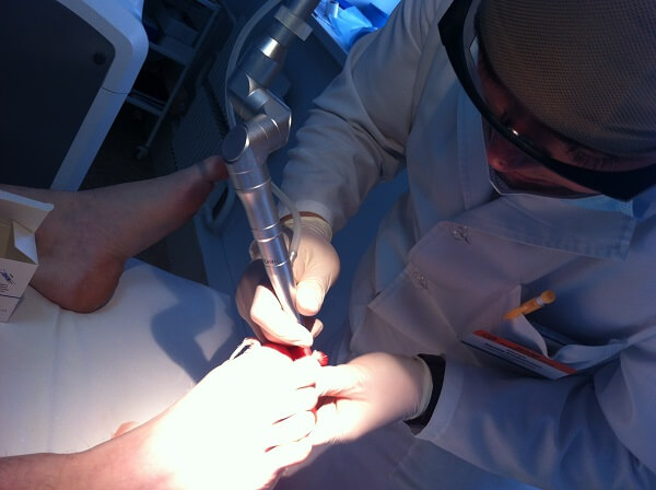 Хирургический метод удаления вросшего ногтя Удаление хирургическим путем