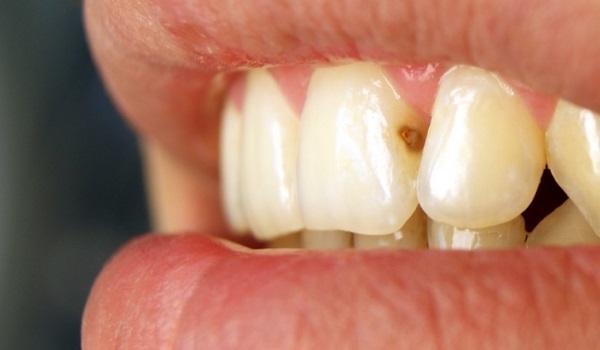 Причины появления кариеса на передних зубах