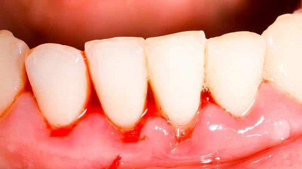 Кровотечение десен стоматологические причины