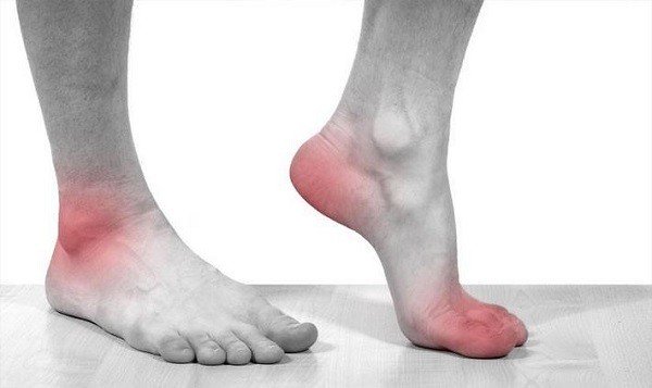 Лечение подагры