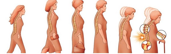 Остеопороз у пожилых женщин причины появления