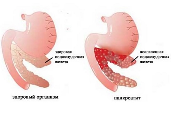 Панкреатит поджелудочной железы