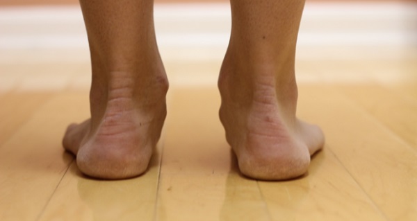 Поперечное плоскостопие 