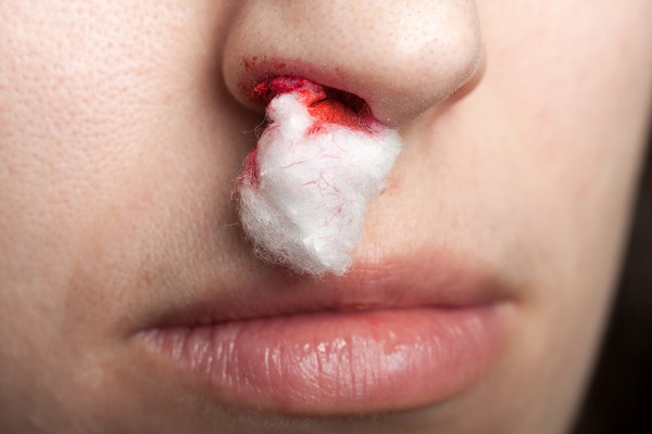 Последствия крови из носа