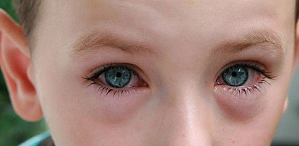 Пути передачи конъюнктивита вирусного типа