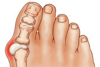 Лечение косточки на ноге у большого пальца народными средствами