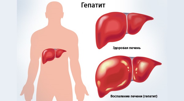 Разновидности гепатита