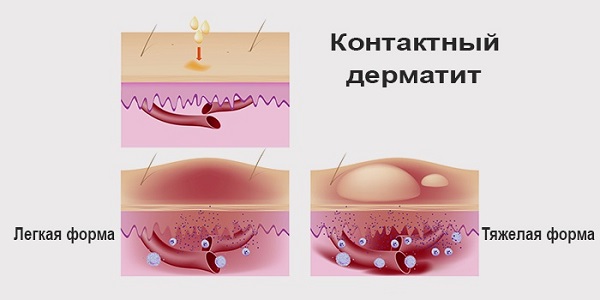 Развитие контактного дерматита