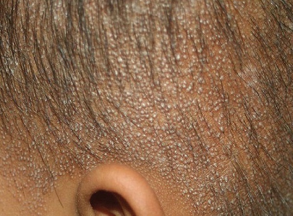 Себорейный гиперкератоз кожи головы