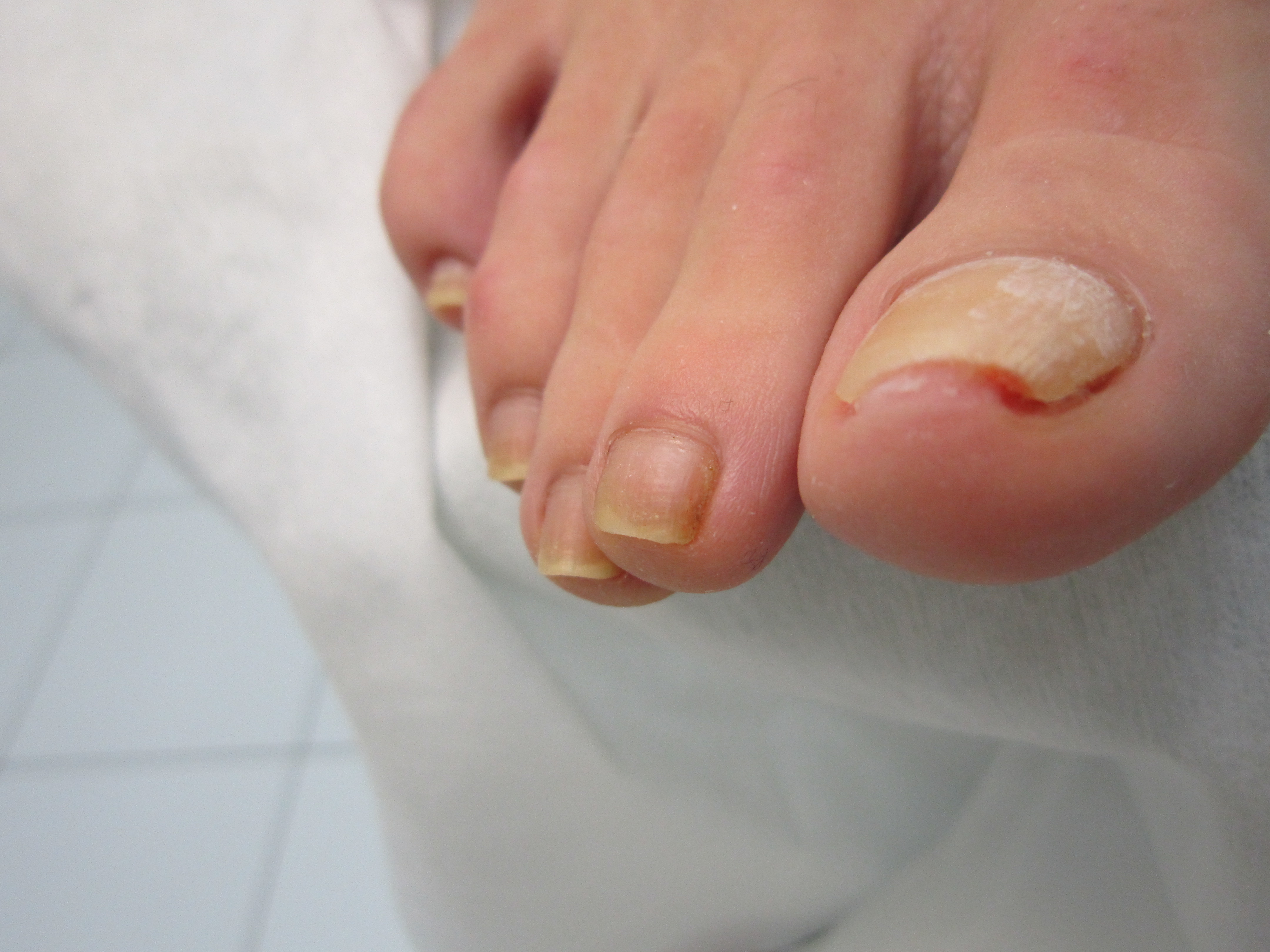Вросший ноготь причины 