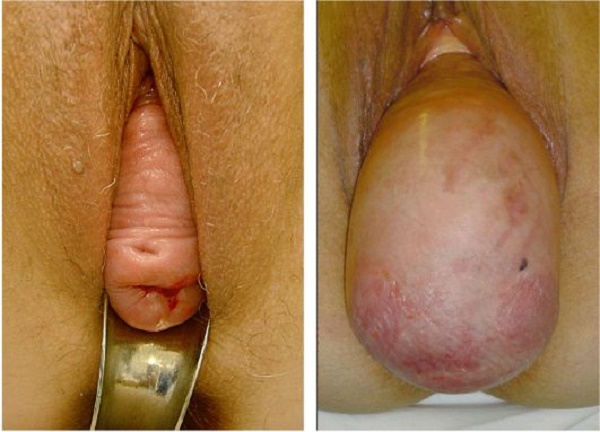 Выпадение матки после родов фото 