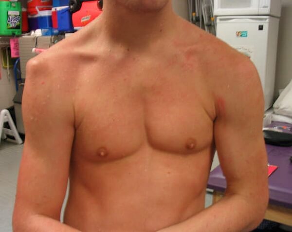 Вывих плечевого сустава симптомы