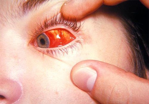 Аллергический конъюнктивит