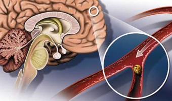 Атеросклероз сосудов головного мозга — лечение народными средствами