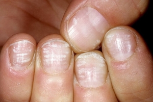 Факторы расслаивания ногтей