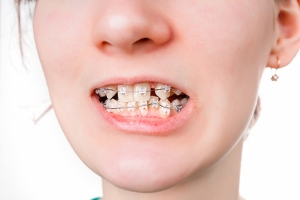 Ровные зубы без врача —возможно ли это