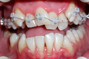 Брекеты для выравнивания зубов