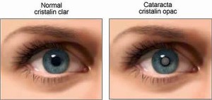 катаракта лечение народными средствами