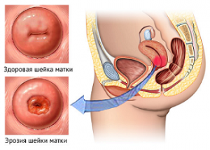 эрозия шейки матки