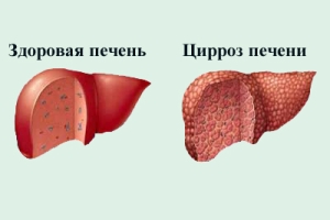Что такое цирроз печени