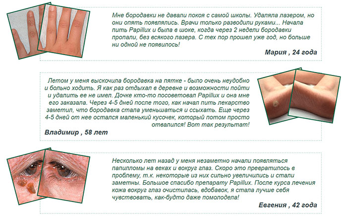 Papillux &ndash; инновационное средство от папиллом и бородавок